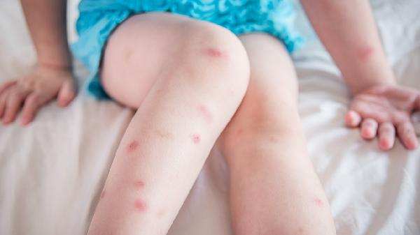 大象腿怎么造成的